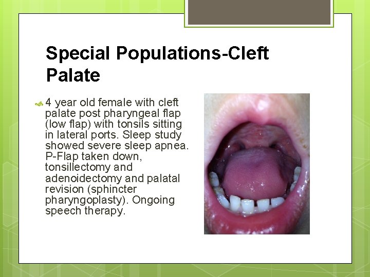 Special Populations-Cleft Palate 4 year old female with cleft palate post pharyngeal flap (low