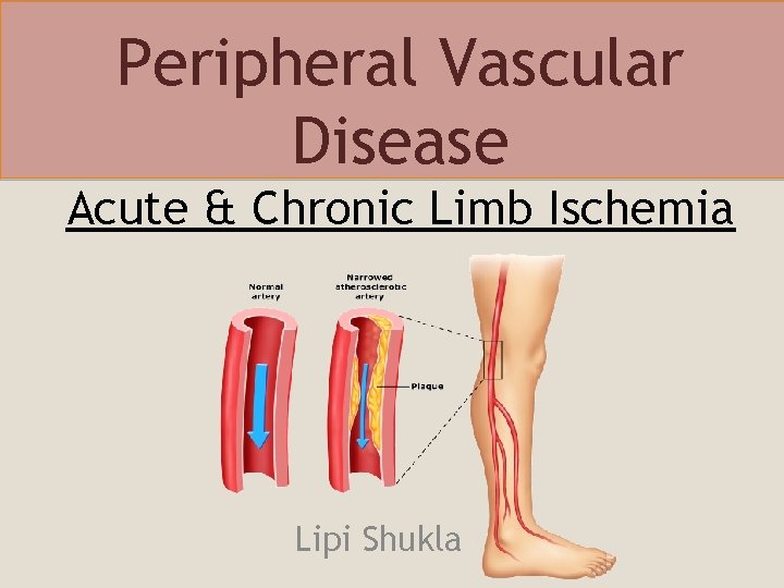 Peripheral Vascular Disease Acute & Chronic Limb Ischemia Lipi Shukla 