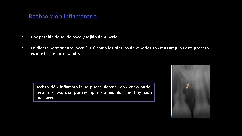 Reabsorción Inflamatoria • Hay perdida de tejido óseo y tejido dentinario. • En diente