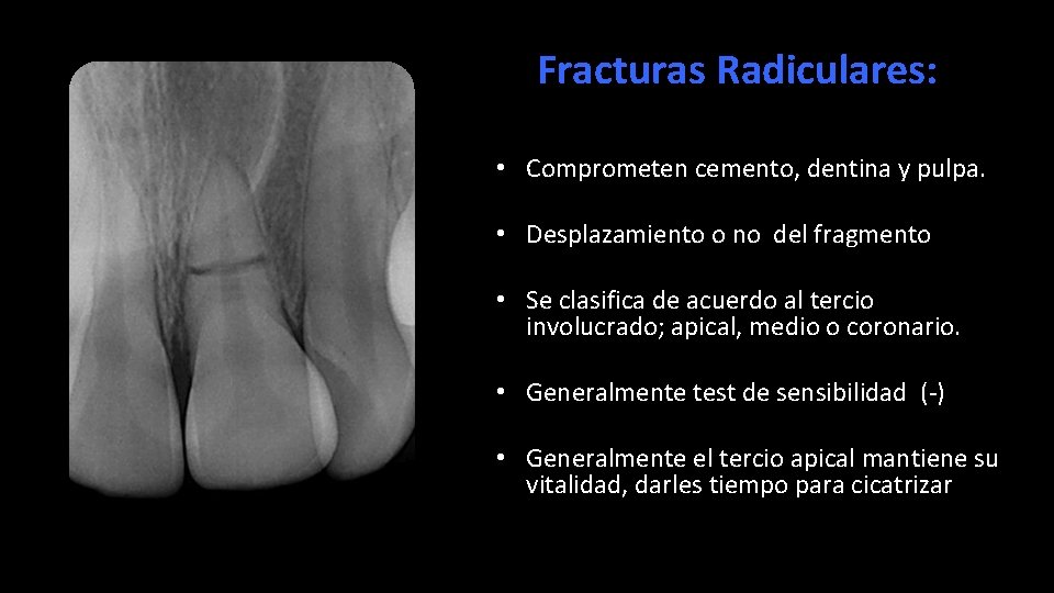 Fracturas Radiculares: • Comprometen cemento, dentina y pulpa. • Desplazamiento o no del fragmento