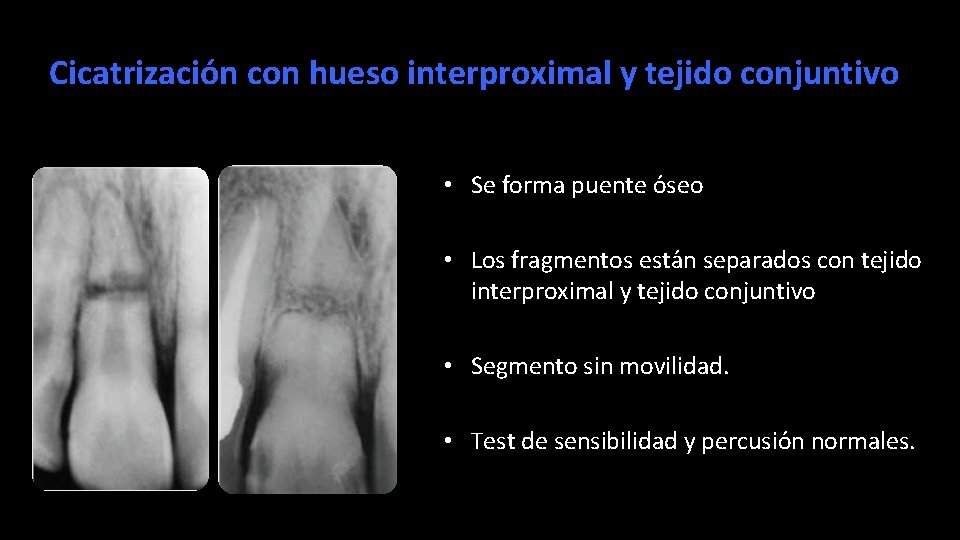 Cicatrizacio n con hueso interproximal y tejido conjuntivo • Se forma puente o seo