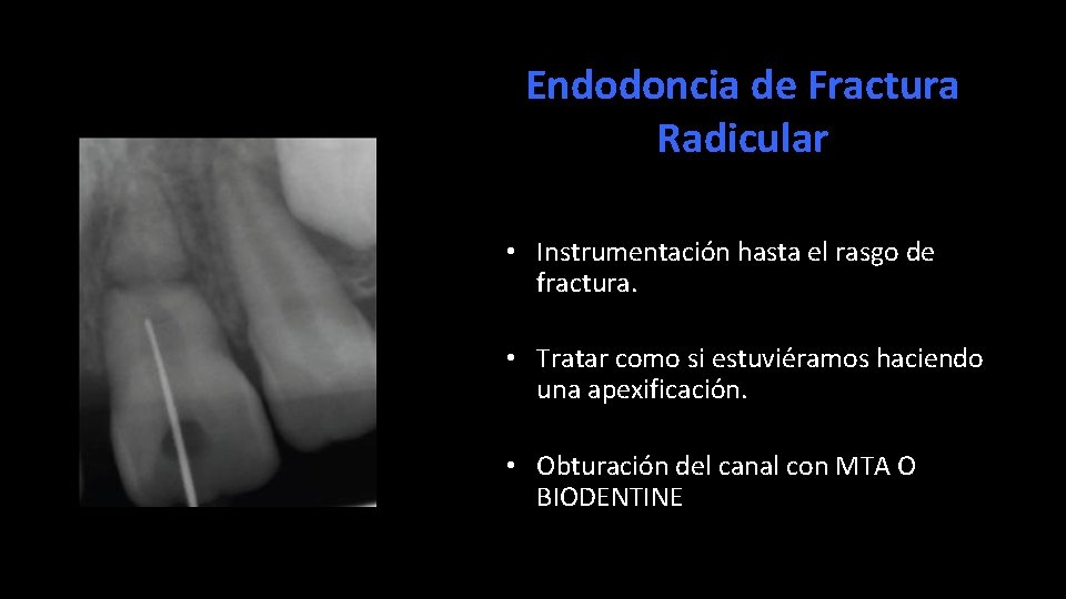 Endodoncia de Fractura Radicular • Instrumentación hasta el rasgo de fractura. • Tratar como