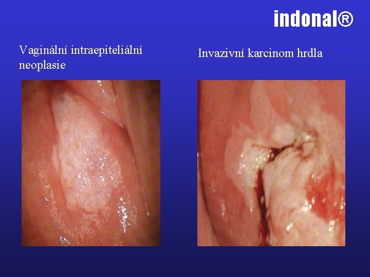 indonal® Vaginální intraepiteliální neoplasie Invazivní karcinom hrdla 