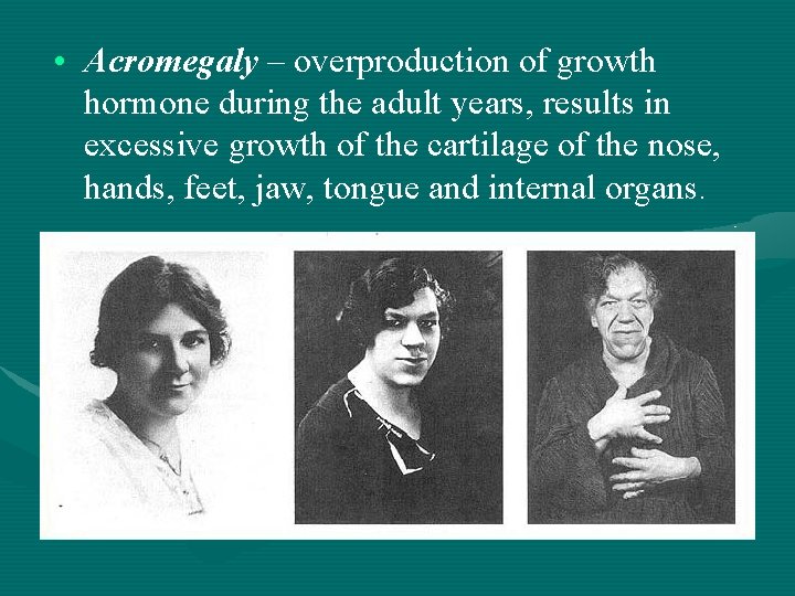  • Acromegaly – overproduction of growth hormone during the adult years, results in