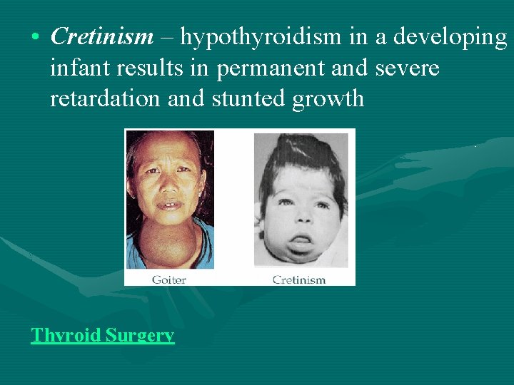  • Cretinism – hypothyroidism in a developing infant results in permanent and severe