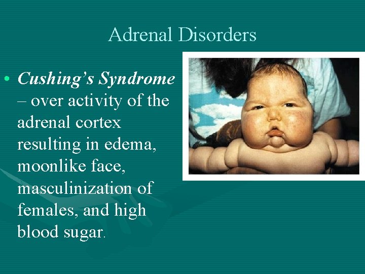 Adrenal Disorders • Cushing’s Syndrome – over activity of the adrenal cortex resulting in