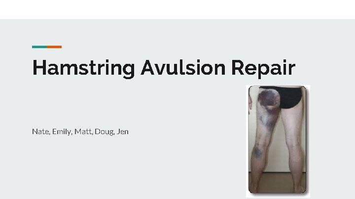 Hamstring Avulsion Repair Nate, Emily, Matt, Doug, Jen 