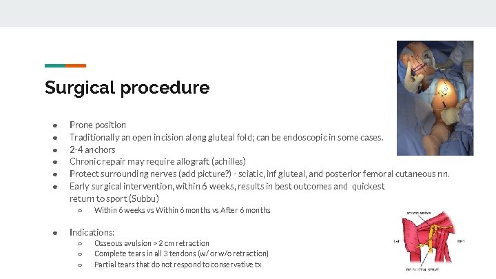 Surgical procedure ● ● ● Prone position Traditionally an open incision along gluteal fold;