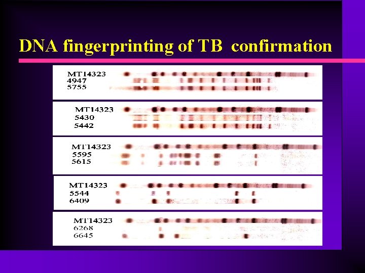 DNA fingerprinting of TB confirmation 