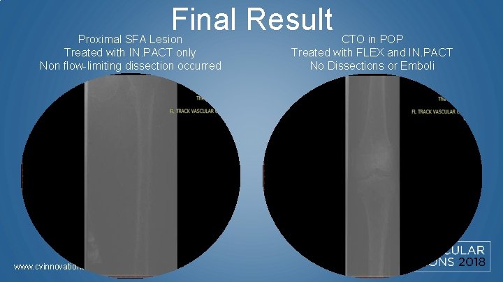 Final Result Proximal SFA Lesion Treated with IN. PACT only Non flow-limiting dissection occurred
