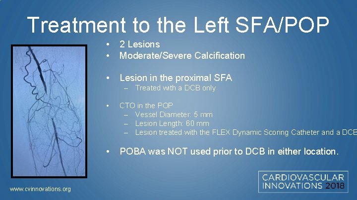Treatment to the Left SFA/POP • • 2 Lesions Moderate/Severe Calcification • Lesion in