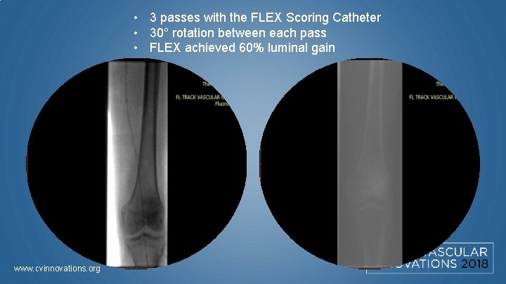  • 3 passes with the FLEX Scoring Catheter • 30° rotation between each