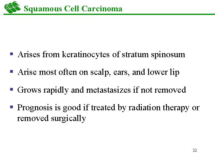 Squamous Cell Carcinoma § Arises from keratinocytes of stratum spinosum § Arise most often