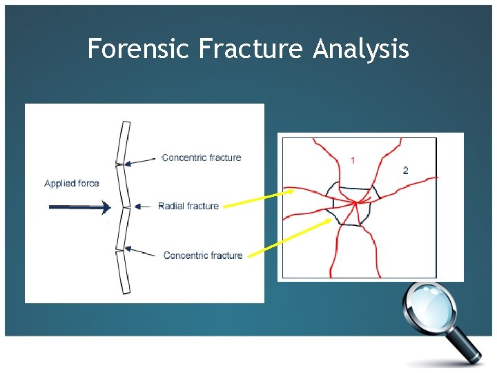 Forensic Fracture Analysis 