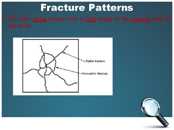 Fracture Patterns § 3 R rule—radial cracks form a right angle on the reverse