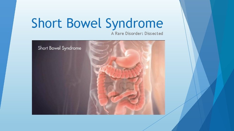 Short Bowel Syndrome A Rare Disorder: Dissected 