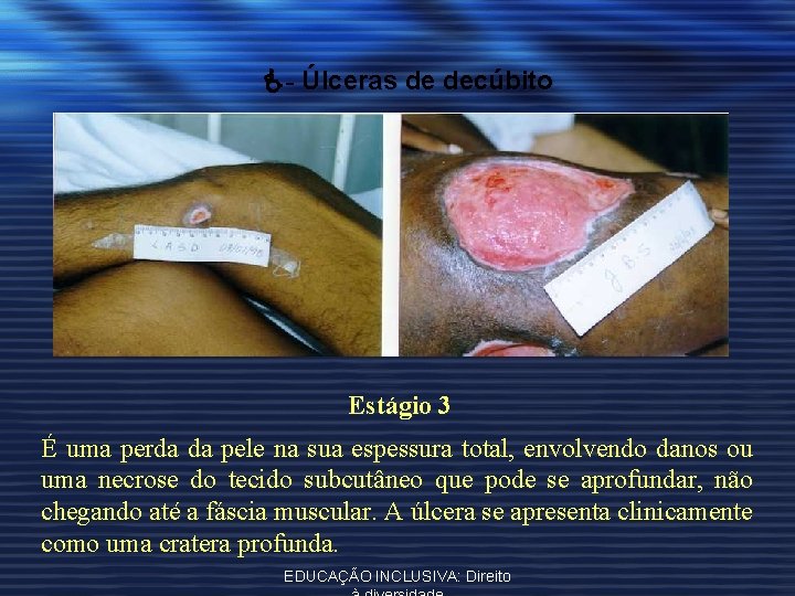  - Úlceras de decúbito Estágio 3 É uma perda da pele na sua