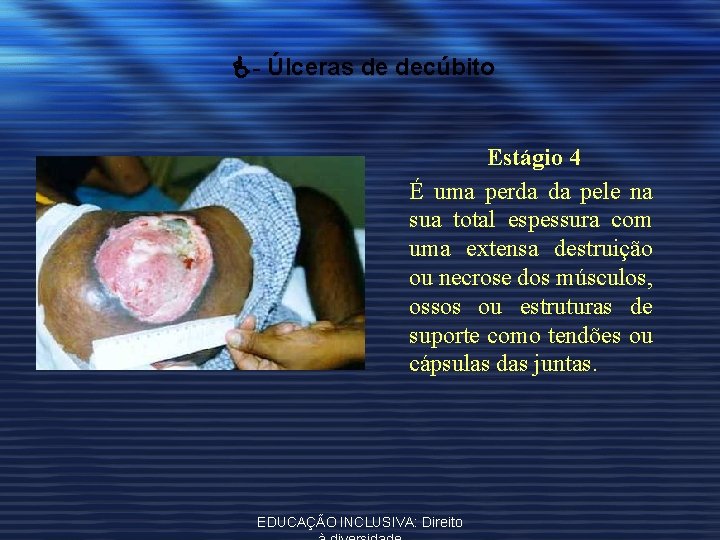  - Úlceras de decúbito Estágio 4 É uma perda da pele na sua