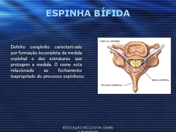 ESPINHA BÍFIDA Defeito congênito caracterizado por formação incompleta da medula espinhal e das estruturas