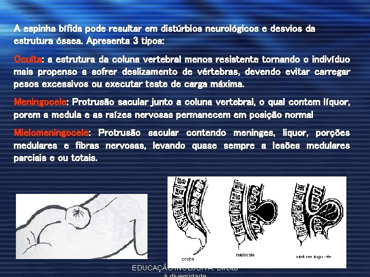 A espinha bífida pode resultar em distúrbios neurológicos e desvios da estrutura óssea. Apresenta