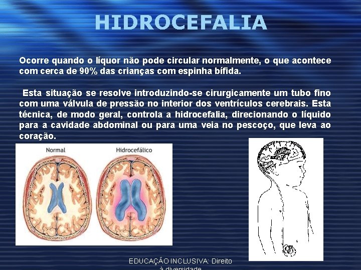 HIDROCEFALIA Ocorre quando o líquor não pode circular normalmente, o que acontece com cerca