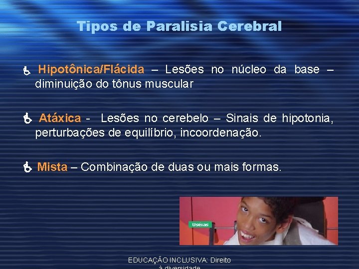 Tipos de Paralisia Cerebral Hipotônica/Flácida – Lesões no núcleo da base – diminuição do