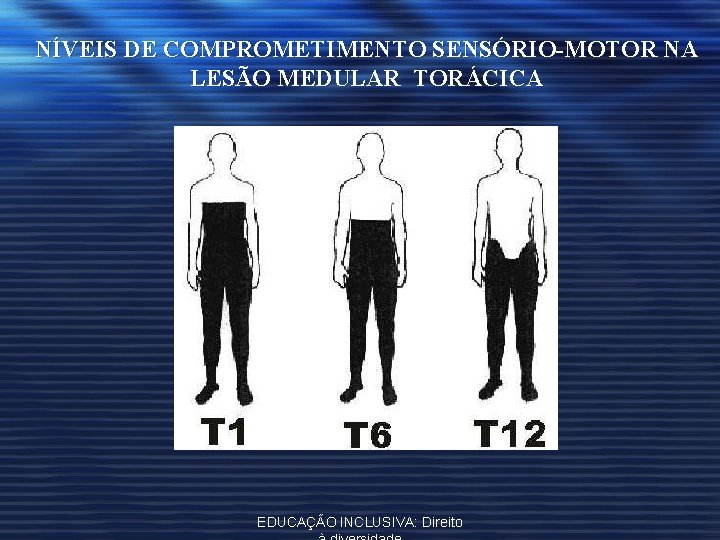 NÍVEIS DE COMPROMETIMENTO SENSÓRIO-MOTOR NA LESÃO MEDULAR TORÁCICA EDUCAÇÃO INCLUSIVA: Direito 