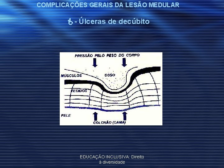 COMPLICAÇÕES GERAIS DA LESÃO MEDULAR - Úlceras de decúbito EDUCAÇÃO INCLUSIVA: Direito à diversidade