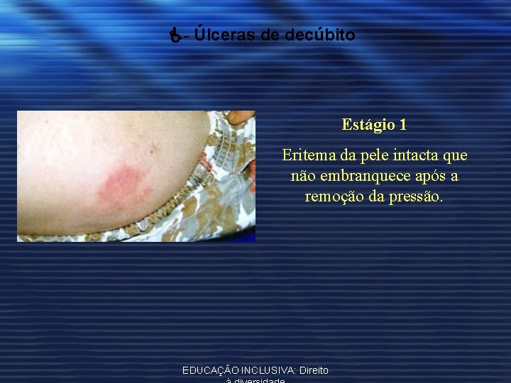  - Úlceras de decúbito Estágio 1 Eritema da pele intacta que não embranquece