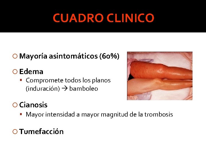CUADRO CLINICO Mayoría asintomáticos (60%) Edema Compromete todos los planos (induración) bamboleo Cianosis Mayor CUADRO CLINICO Mayoría asintomáticos (60%) Edema Compromete todos los planos (induración) bamboleo Cianosis Mayor
