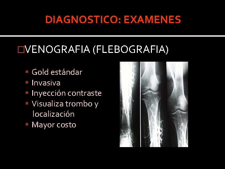 DIAGNOSTICO: EXAMENES �VENOGRAFIA (FLEBOGRAFIA) Gold estándar Invasiva Inyección contraste Visualiza trombo y localización Mayor DIAGNOSTICO: EXAMENES �VENOGRAFIA (FLEBOGRAFIA) Gold estándar Invasiva Inyección contraste Visualiza trombo y localización Mayor
