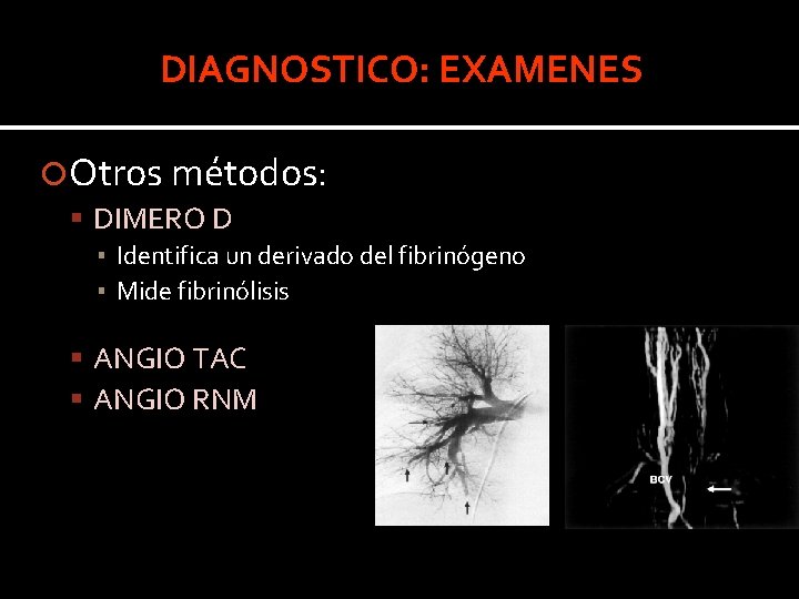 DIAGNOSTICO: EXAMENES Otros métodos: DIMERO D ▪ Identifica un derivado del fibrinógeno ▪ Mide DIAGNOSTICO: EXAMENES Otros métodos: DIMERO D ▪ Identifica un derivado del fibrinógeno ▪ Mide