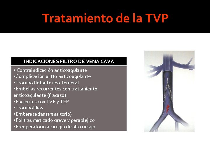 Tratamiento de la TVP INDICACIONES FILTRO DE VENA CAVA • Contraindicación anticoagulante • Complicación Tratamiento de la TVP INDICACIONES FILTRO DE VENA CAVA • Contraindicación anticoagulante • Complicación