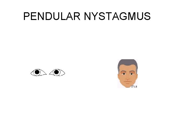 PENDULAR NYSTAGMUS 