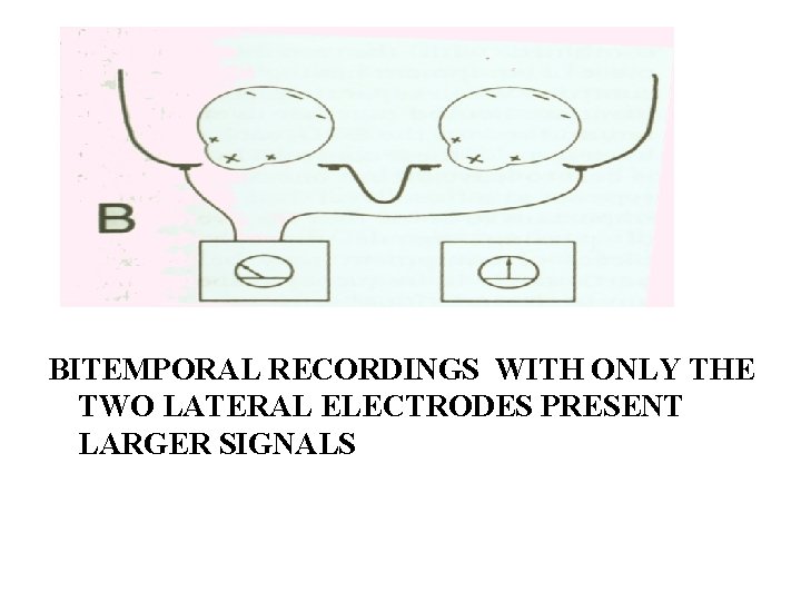 BITEMPORAL RECORDINGS WITH ONLY THE TWO LATERAL ELECTRODES PRESENT LARGER SIGNALS 