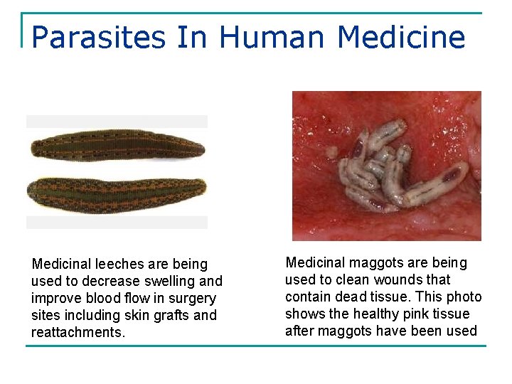 Parasites In Human Medicine Medicinal leeches are being used to decrease swelling and improve