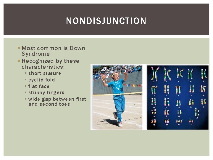 NONDISJUNCTION § Most common is Down Syndrome § Recognized by these characteristics: § §
