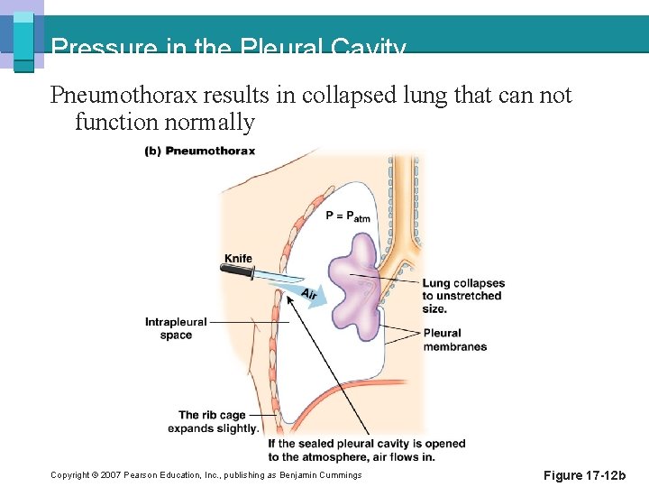 Pressure in the Pleural Cavity Pneumothorax results in collapsed lung that can not function