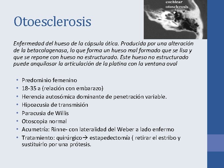 Otoesclerosis Enfermedad del hueso de la cápsula ótica. Producida por una alteración de la