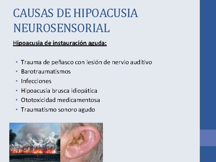 CAUSAS DE HIPOACUSIA NEUROSENSORIAL Hipoacusia de instauración aguda: • • • Trauma de peñasco