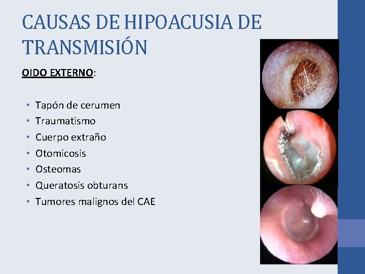 CAUSAS DE HIPOACUSIA DE TRANSMISIÓN OIDO EXTERNO: • • Tapón de cerumen Traumatismo Cuerpo