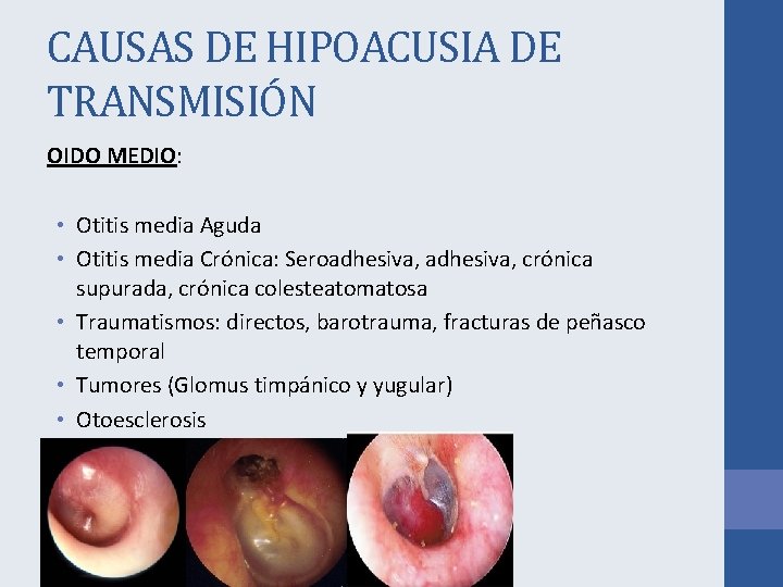 CAUSAS DE HIPOACUSIA DE TRANSMISIÓN OIDO MEDIO: • Otitis media Aguda • Otitis media