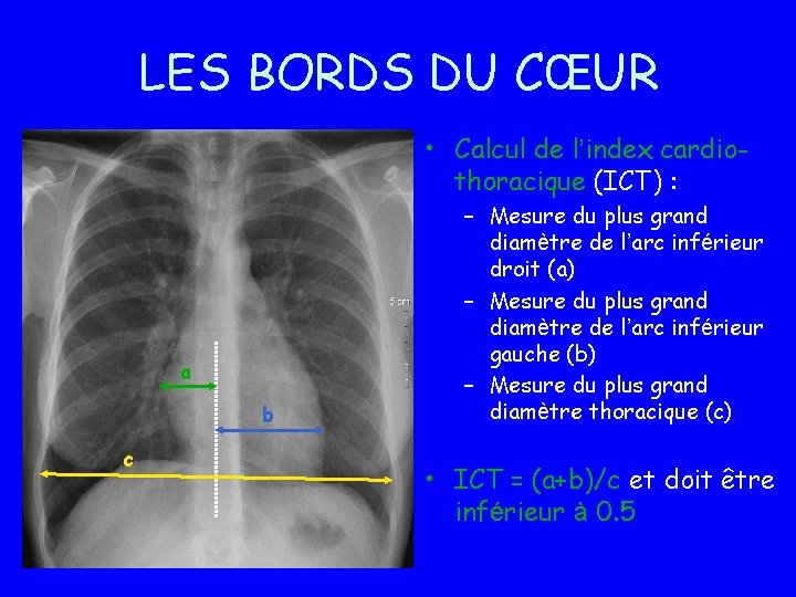 LES BORDS DU CŒUR • Calcul de l’index cardiothoracique (ICT) : a b c