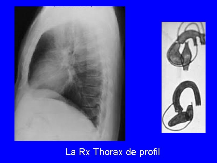 La Rx Thorax de profil 