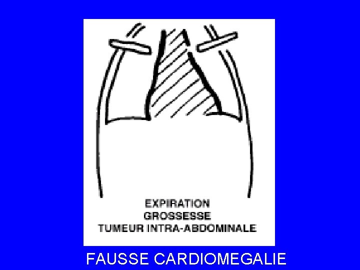 FAUSSE CARDIOMEGALIE 