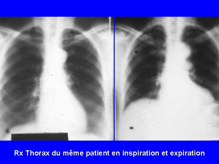 Rx Thorax du même patient en inspiration et expiration 