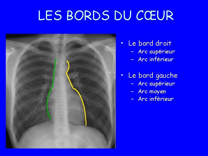 LES BORDS DU CŒUR • Le bord droit – Arc supérieur – Arc inférieur