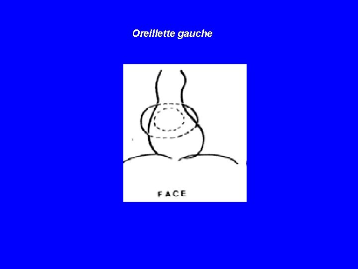 Oreillette gauche 