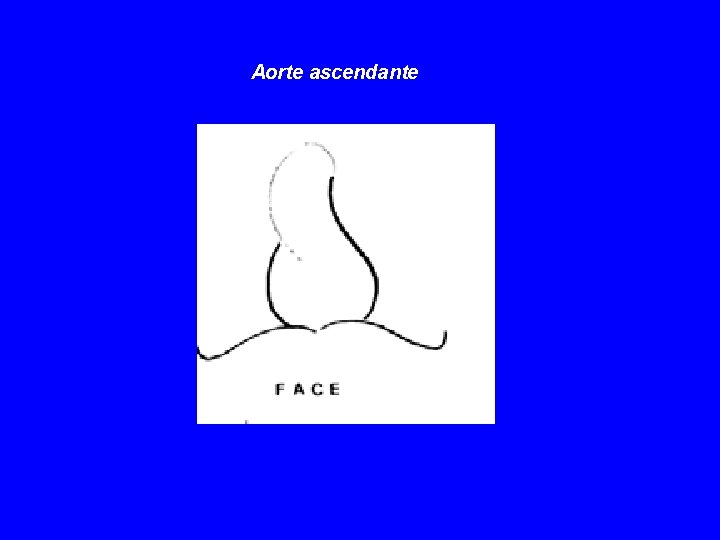 Aorte ascendante 