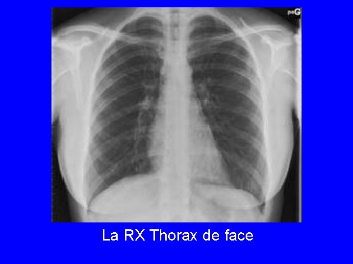 La RX Thorax de face 